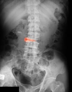 An x-ray depicting ankylosing spondylitis in the lower spine.