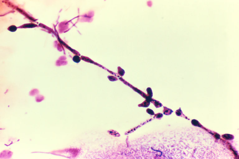 Candida albicans en un frotis vaginal teñido con la técnica de Gram de una paciente con candidiasis vaginal, donde se observa el hongo de aspecto tubula (hifas) de este hongo