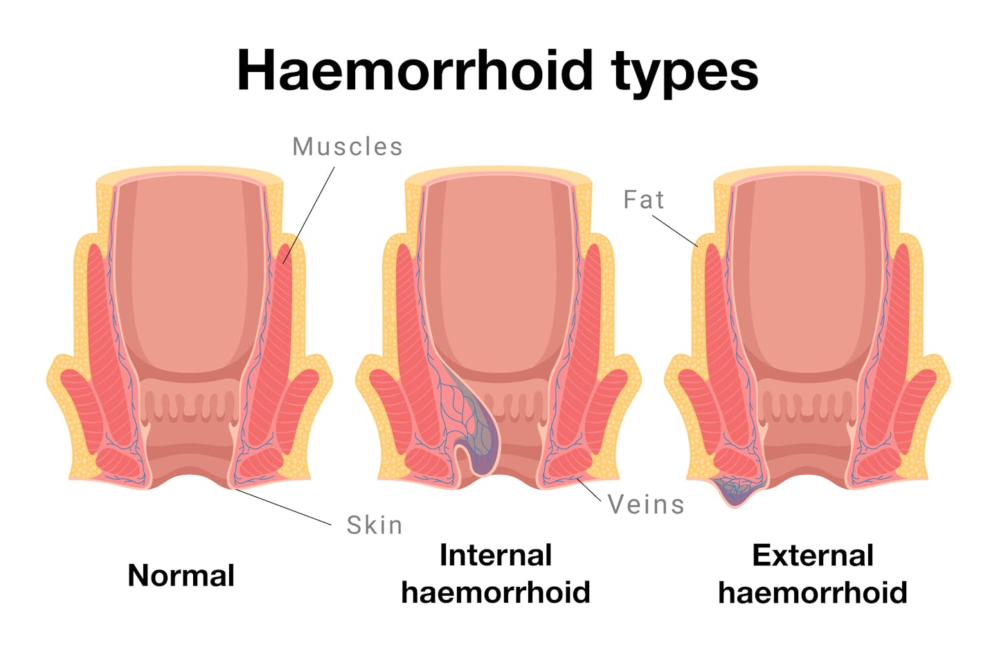 Diagram showing haemorrhoid types: normal, internal and external.