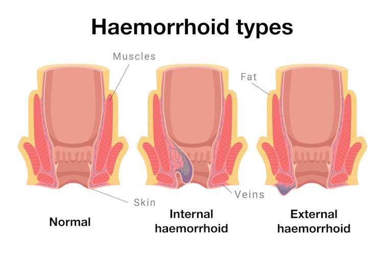 Diagram showing haemorrhoid types: normal, internal and external.