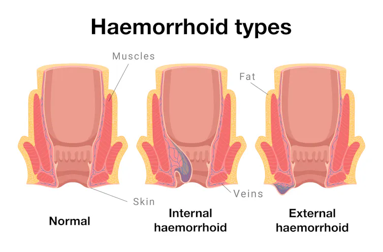 Diagram showing haemorrhoid types: normal, internal and external.