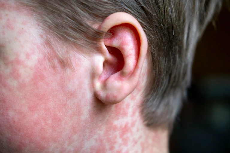 Child with measles rash all down the side of his head.