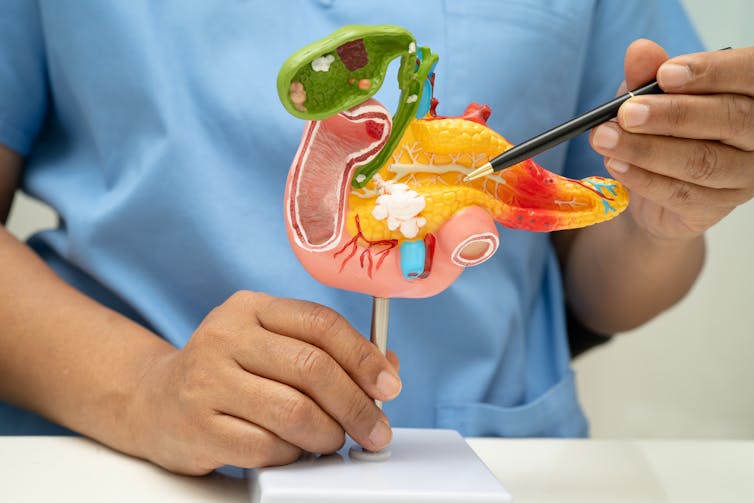 A doctor or nurse wearing blue scrubs uses a pen to point at a diagram of the pancreas.