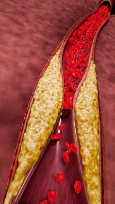 Three-dimensional medical concept of narrowing of an artery