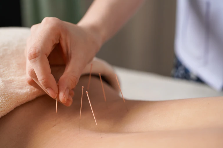 Person receiving acupuncture treatment.