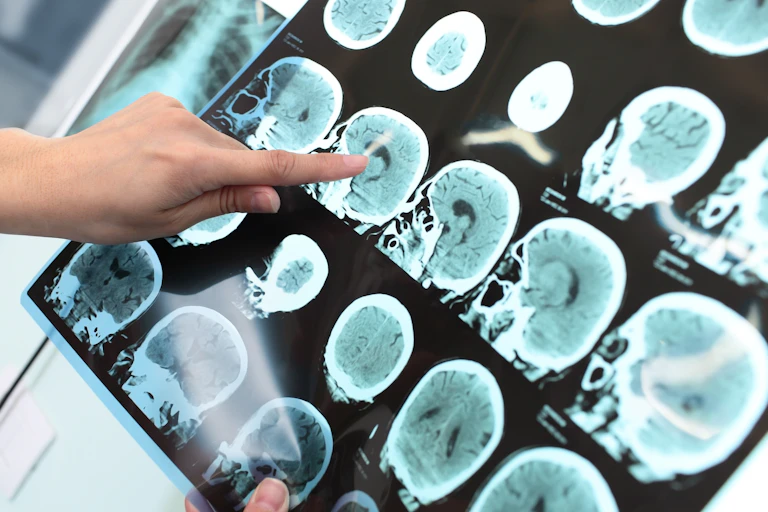Un dedo señala imágenes del cerebro tomadas con tomografía.