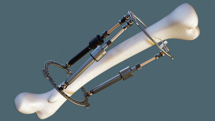 A digital drawing depicting a leg bone with a metal frame screwed into it.