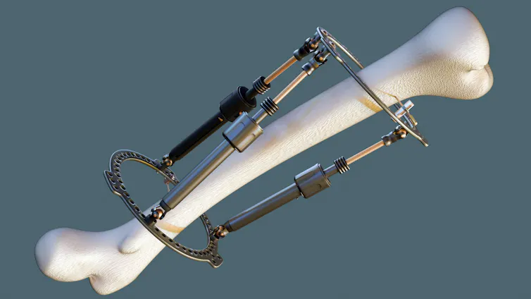 A digital drawing depicting a leg bone with a metal frame screwed into it.