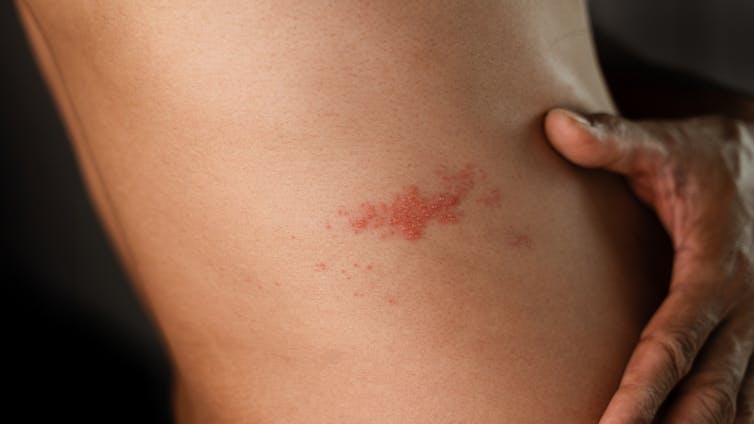 An adult with a shingles rash.