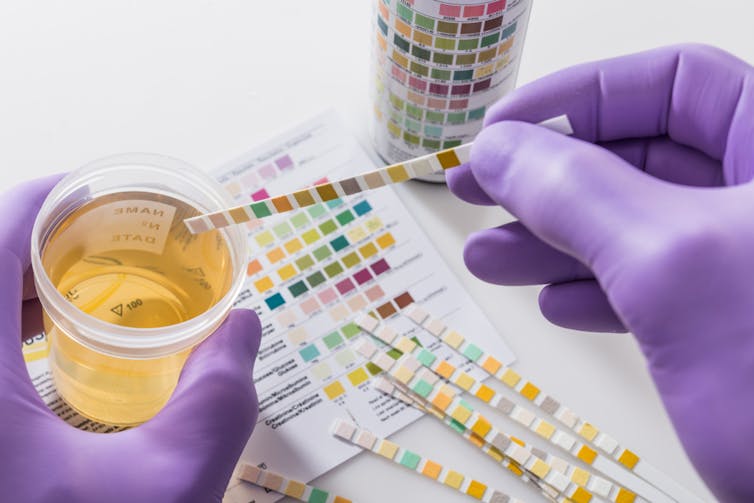 Gloved hands holding a urine sample and a dipstick.