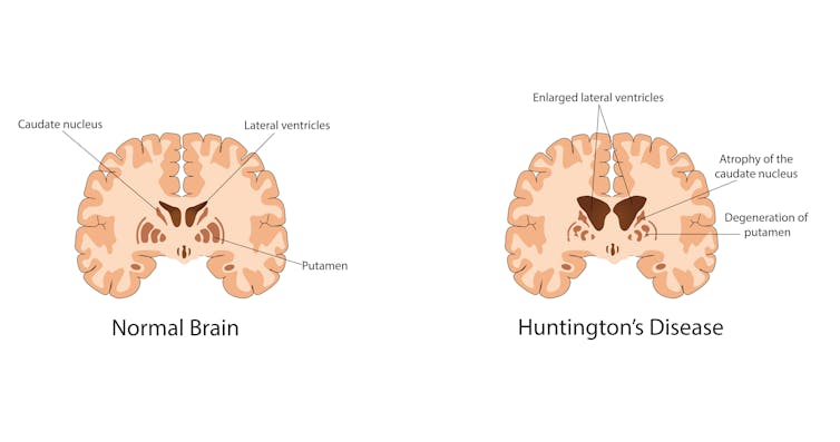 Diagram comparing normal brain to brain with Huntington's disease.