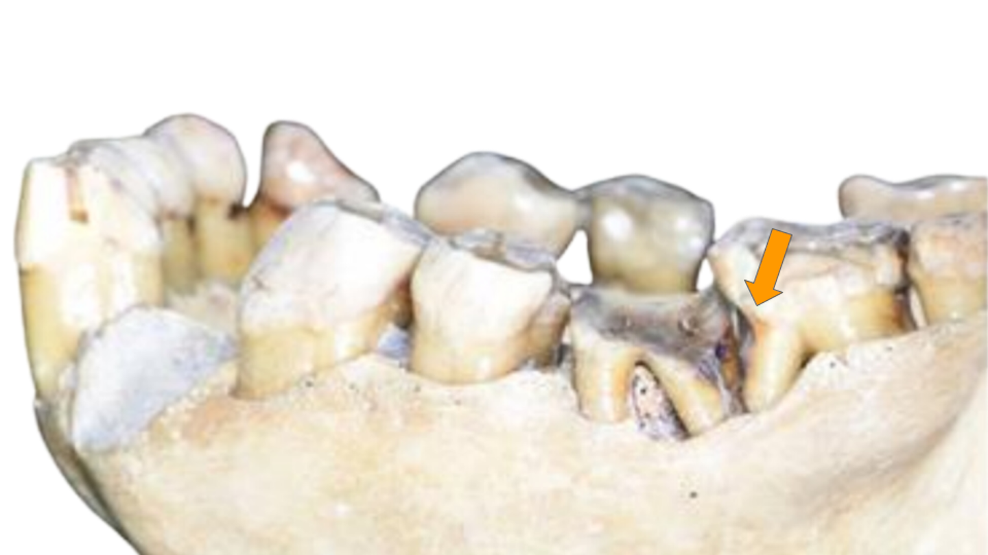 Orangutan mandible showing a full dentition, with one tooth displaying an unusual groove on its root.