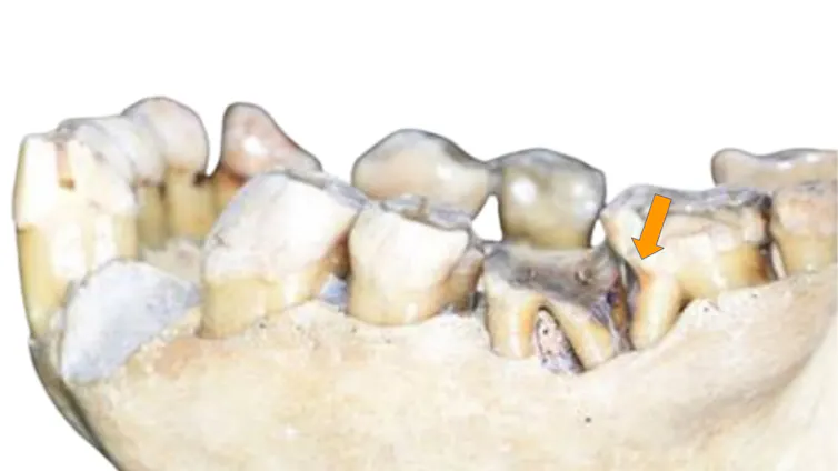 Orangutan mandible showing a full dentition, with one tooth displaying an unusual groove on its root.