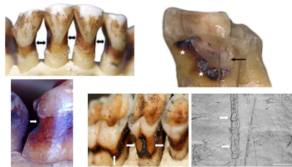 Denticiones de primates con diferentes tipos de patologías dentales.