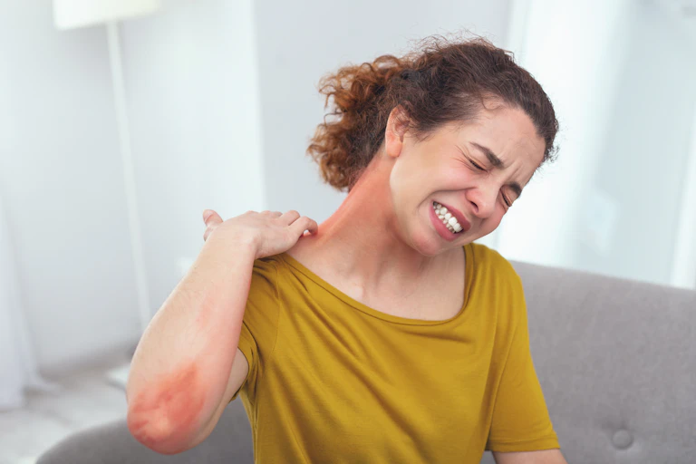 Mulher com comichão e erupção cutânea vermelha dolorosa que cobre o pescoço e os braços