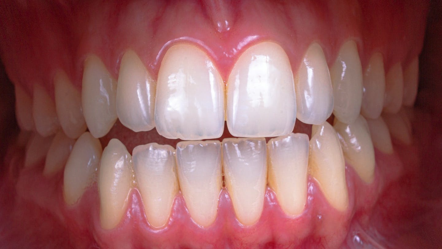 Close-up of mouth, showing teeth and gums.