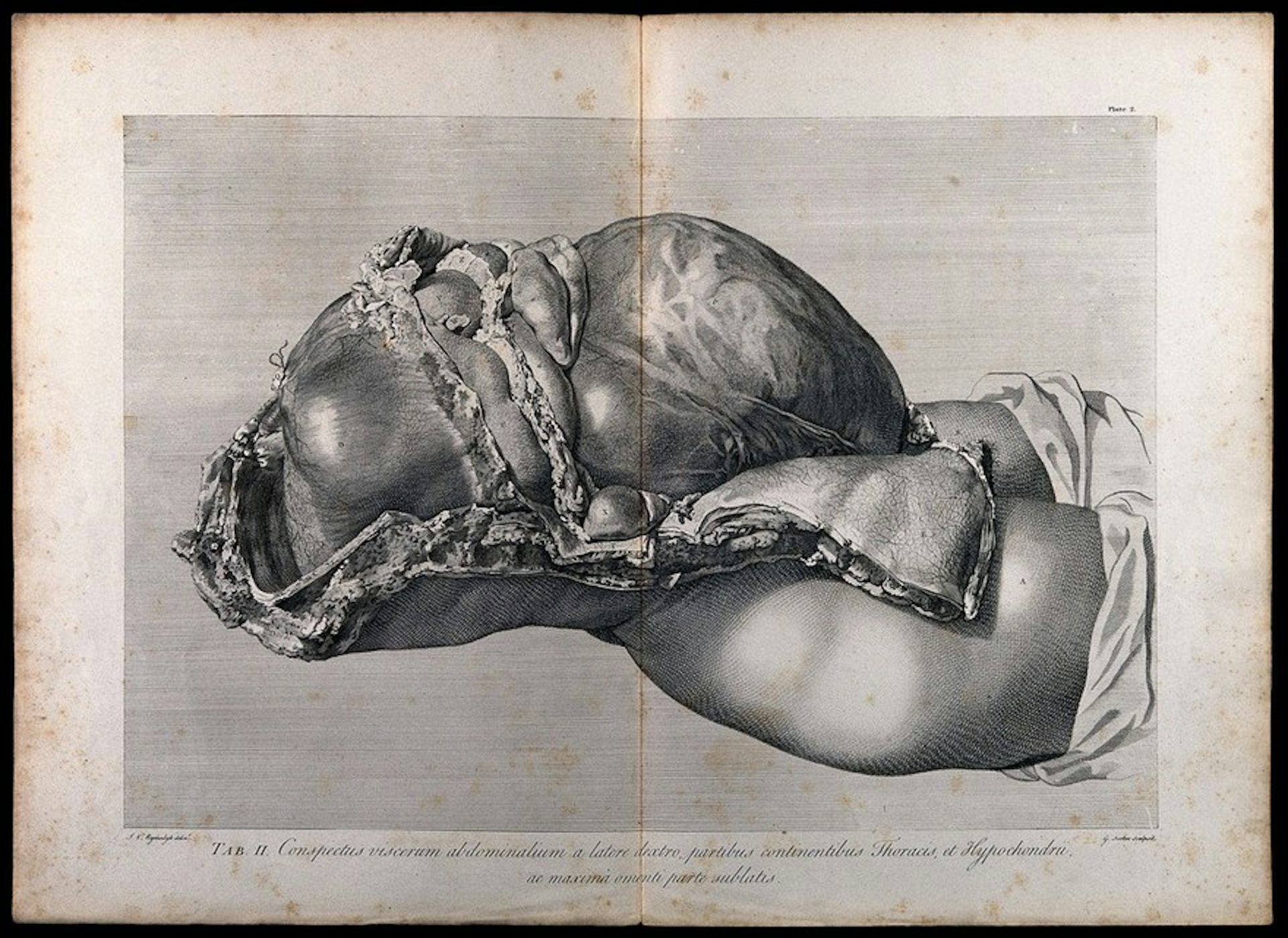Dissection of the pregnant female abdomen, showing the skin peeled away to reveal the swollen uterus.