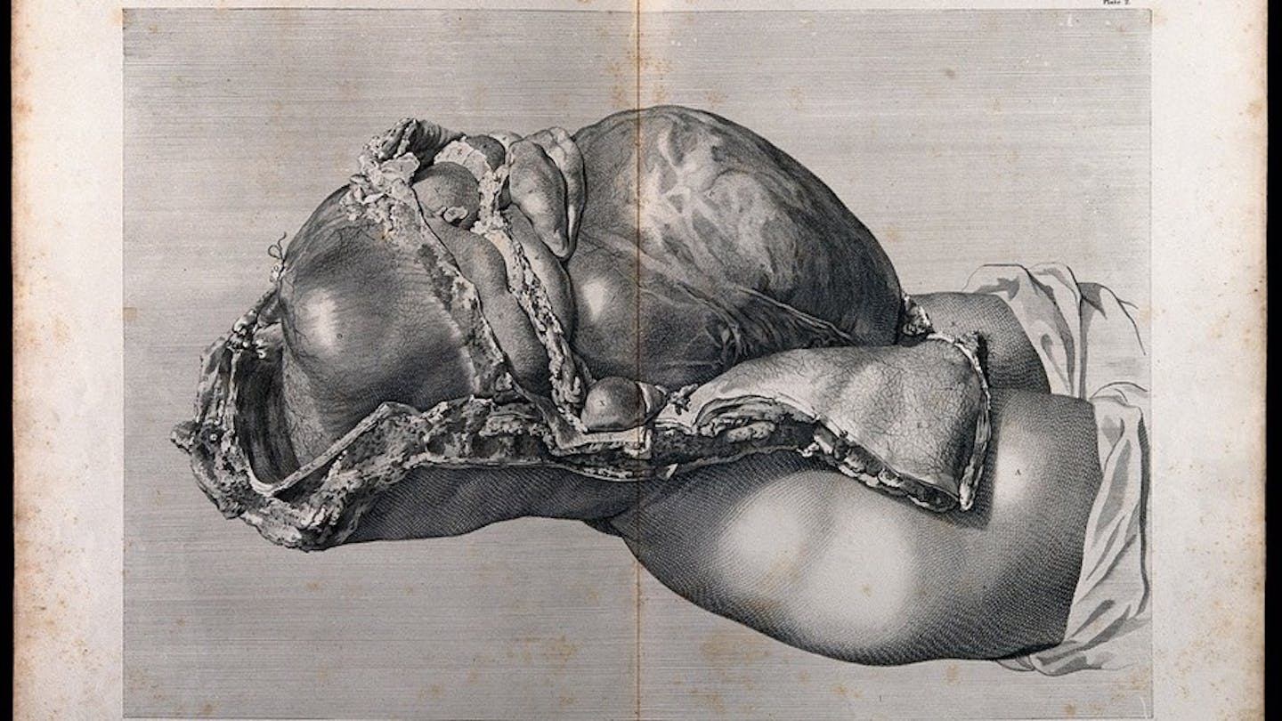 Dissection of the pregnant female abdomen, showing the skin peeled away to reveal the swollen uterus.