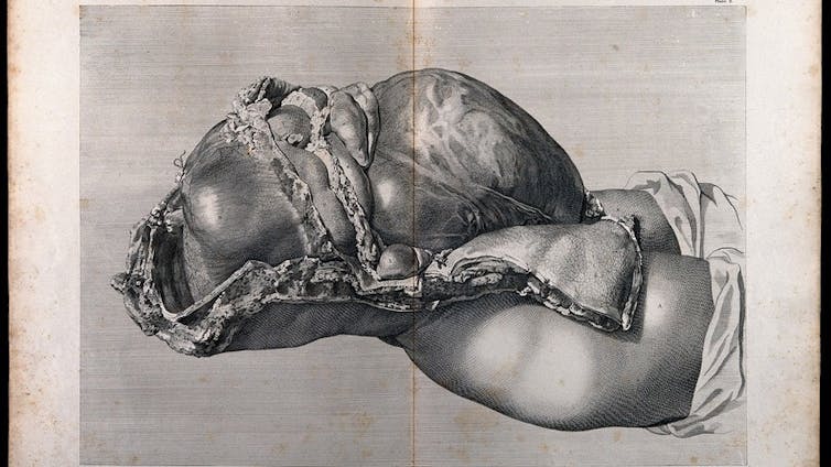 Pregnant women's stomach dishes, in which the skin is sprinkled to show the uterus.