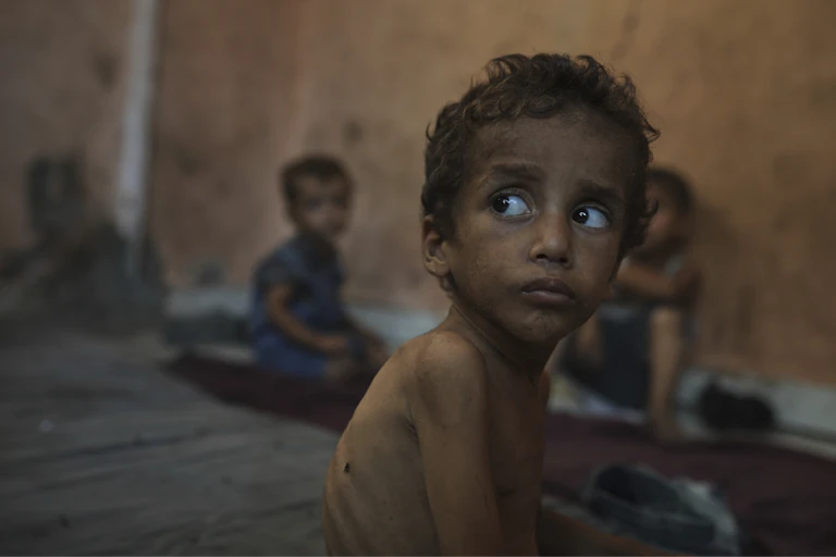 Yazan Abu Ful, a 2-year-old malnourished child, sits at his family home in the Shati refugee camp in Gaza City on Wednesday, July 23, 2025