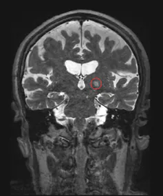 Frontal brain MRI