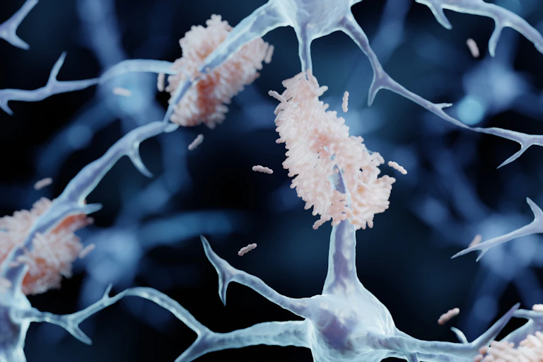 Ilustración médica de una sustancia acumulada entre neuronas.