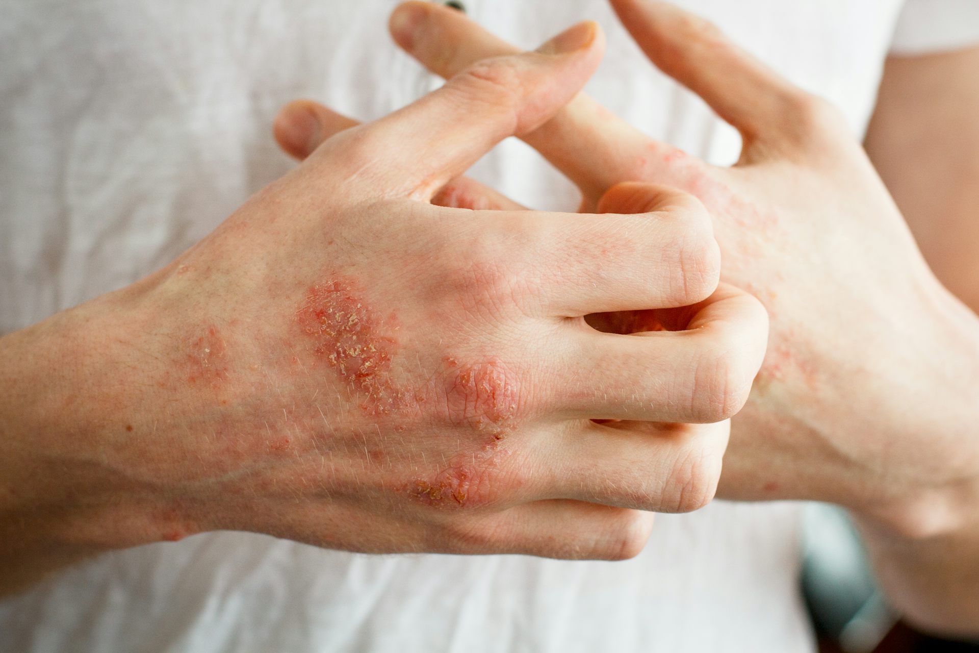 A person scratches at eczema patches on their hands.