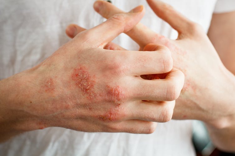 A person scratches at eczema patches on their hands.