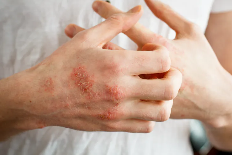A person scratches at eczema patches on their hands.