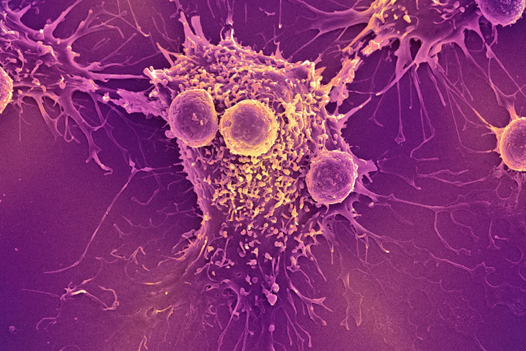 Scanning electron micrograph image of immune cells attached to cancer cells, against a purple background.