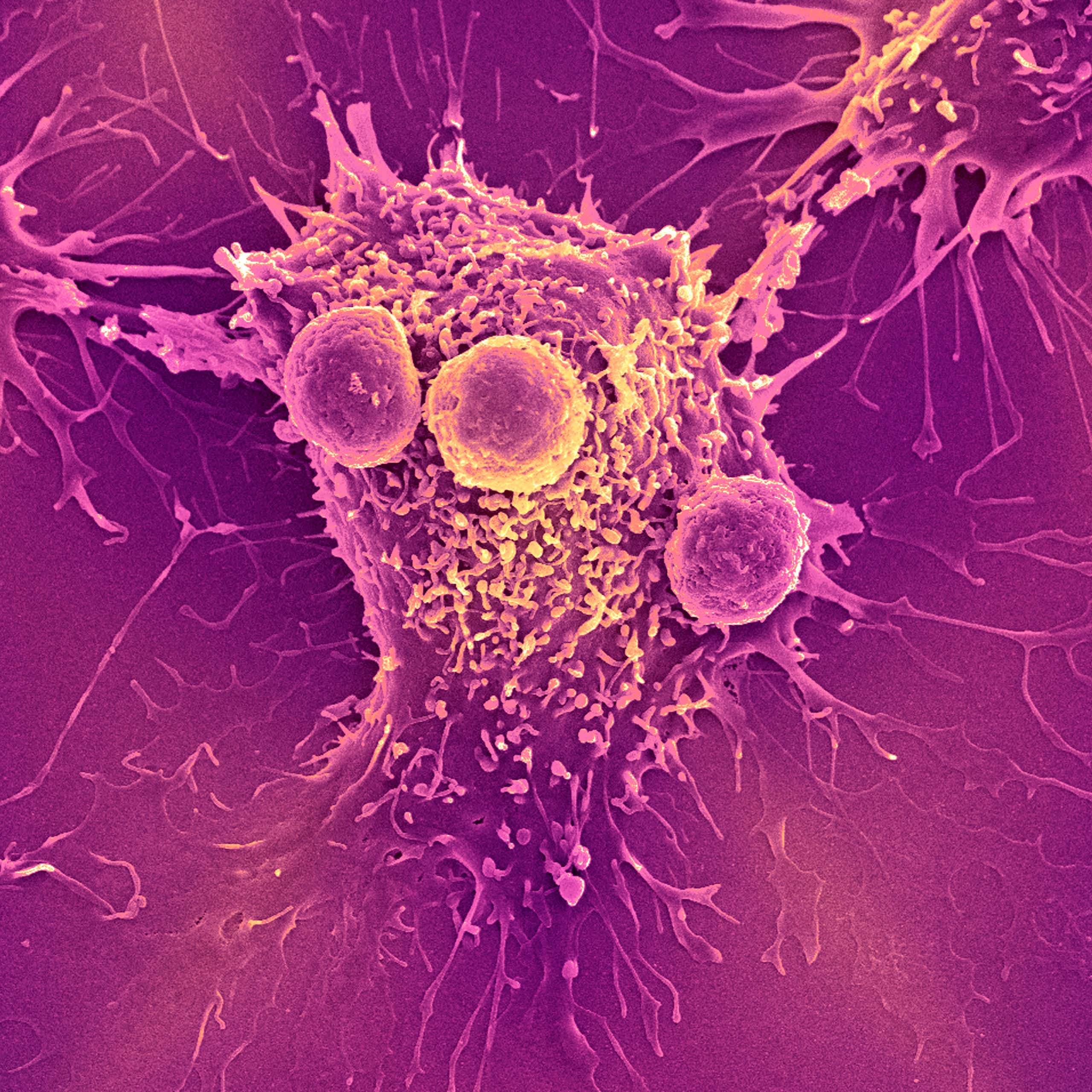 Scanning electron micrograph image of immune cells attached to cancer cells, against a purple background.