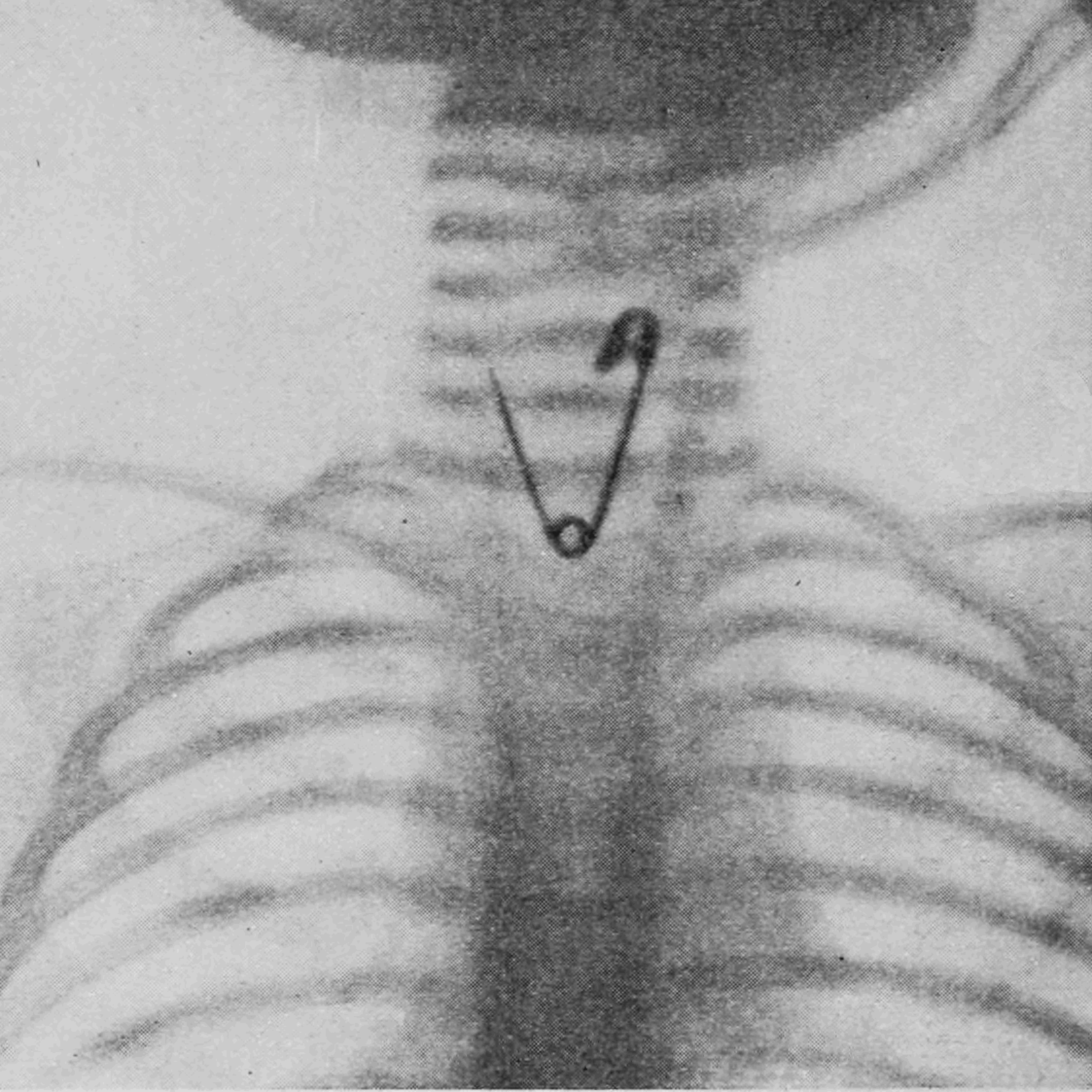 De agulhas a projéteis: a tecnologia que encontra metais perdidos no corpo