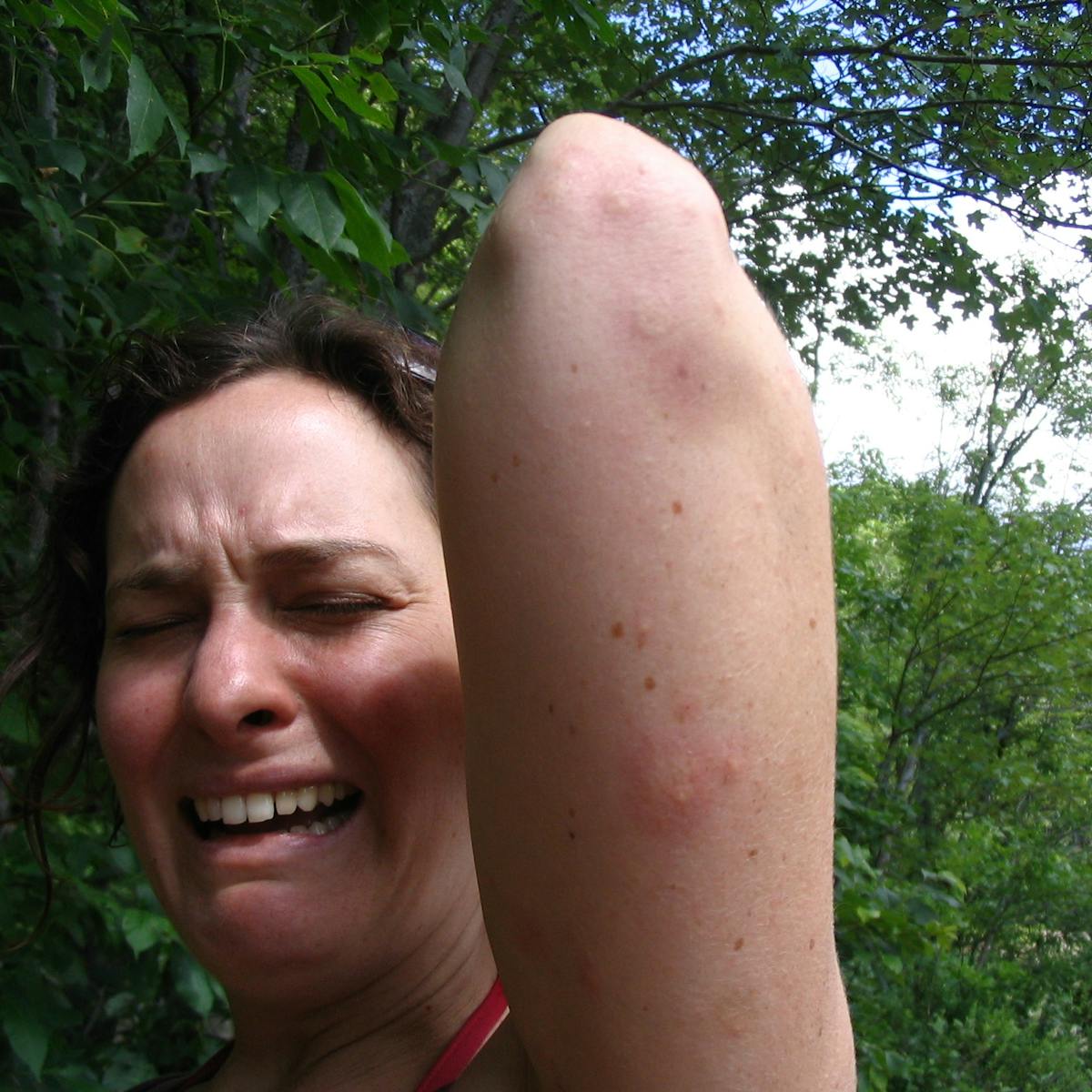 Health Check Why Mosquitoes Seem To Bite Some People More