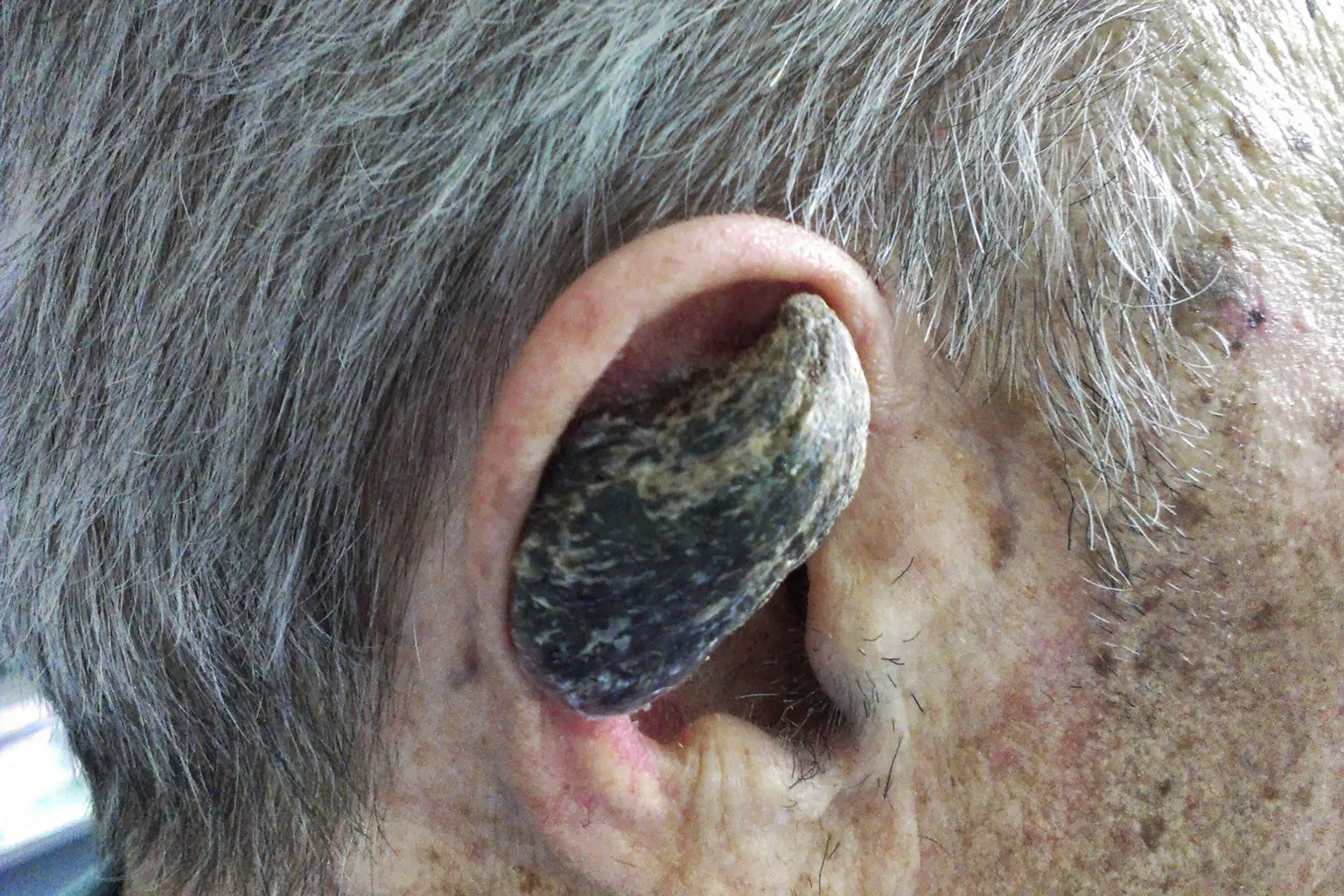 What This Strange Cutaneous Horn Looks Like Might Change How You View Your Skin Forever