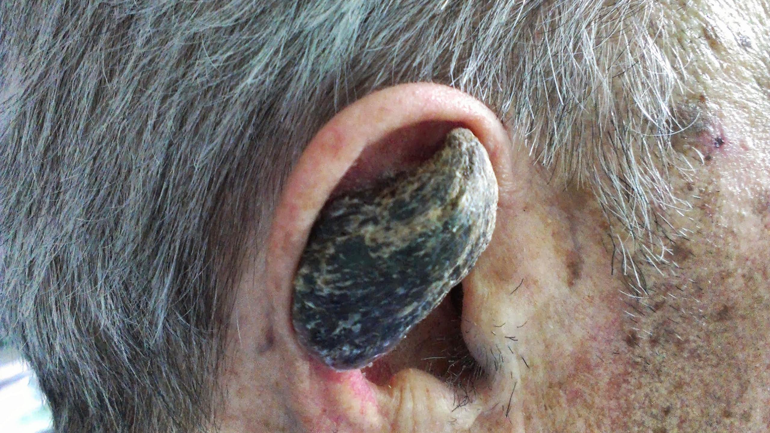 Why some humans grow horns