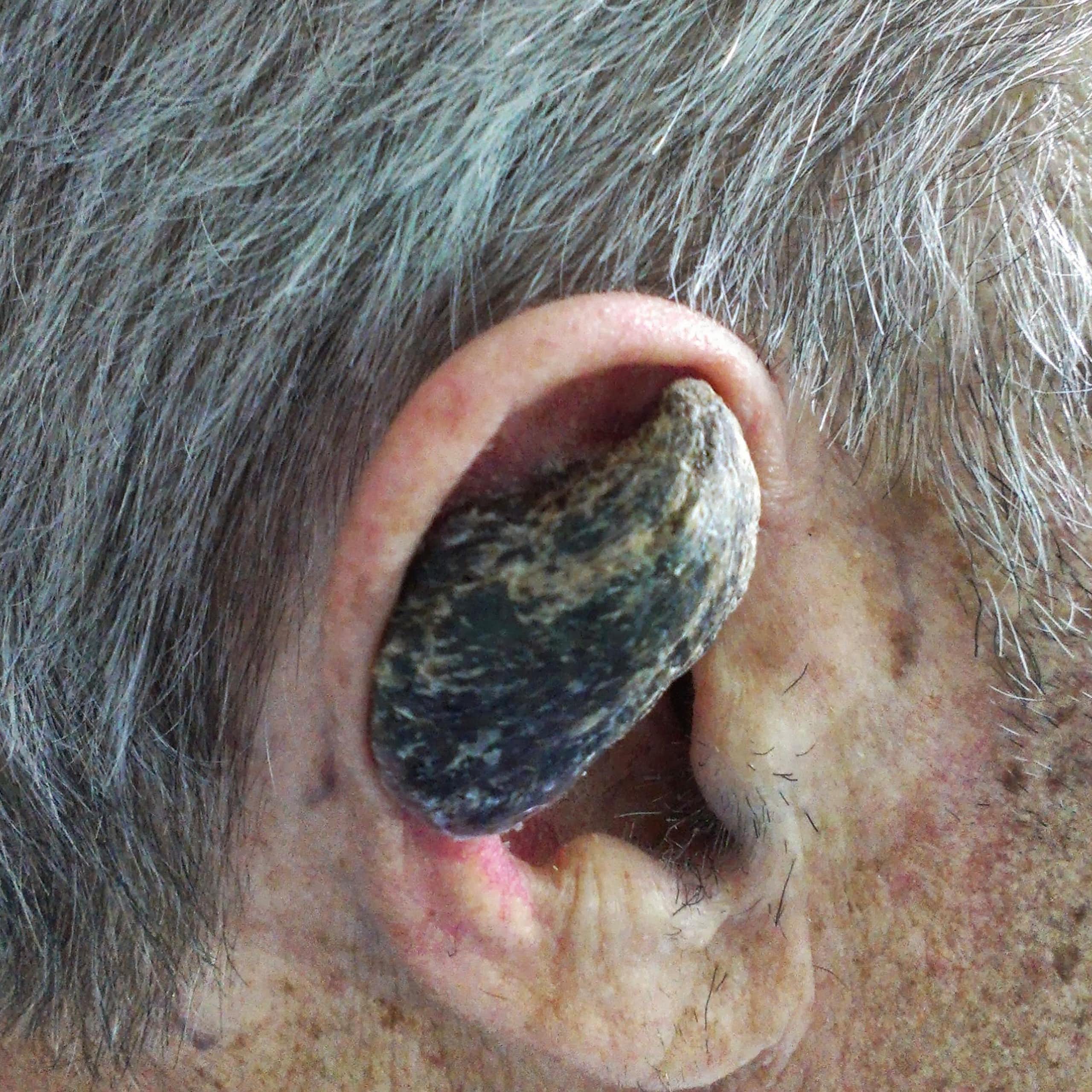 Why some humans grow horns