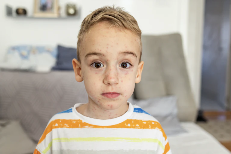 Boy with chickenpox looks at the camera