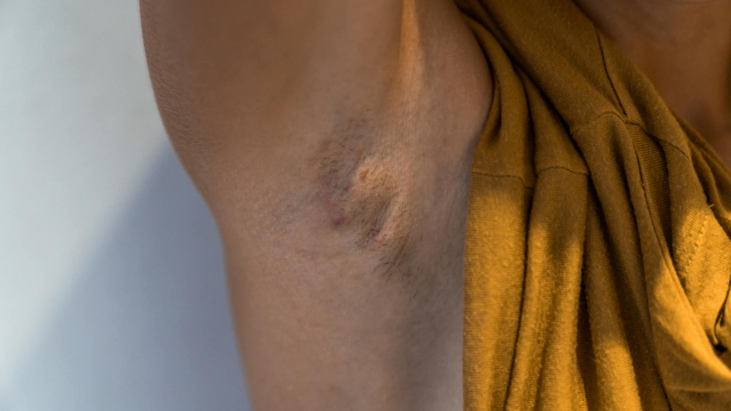 Hidradenitis suppurativa: the painful skin condition that can hide in plain sight