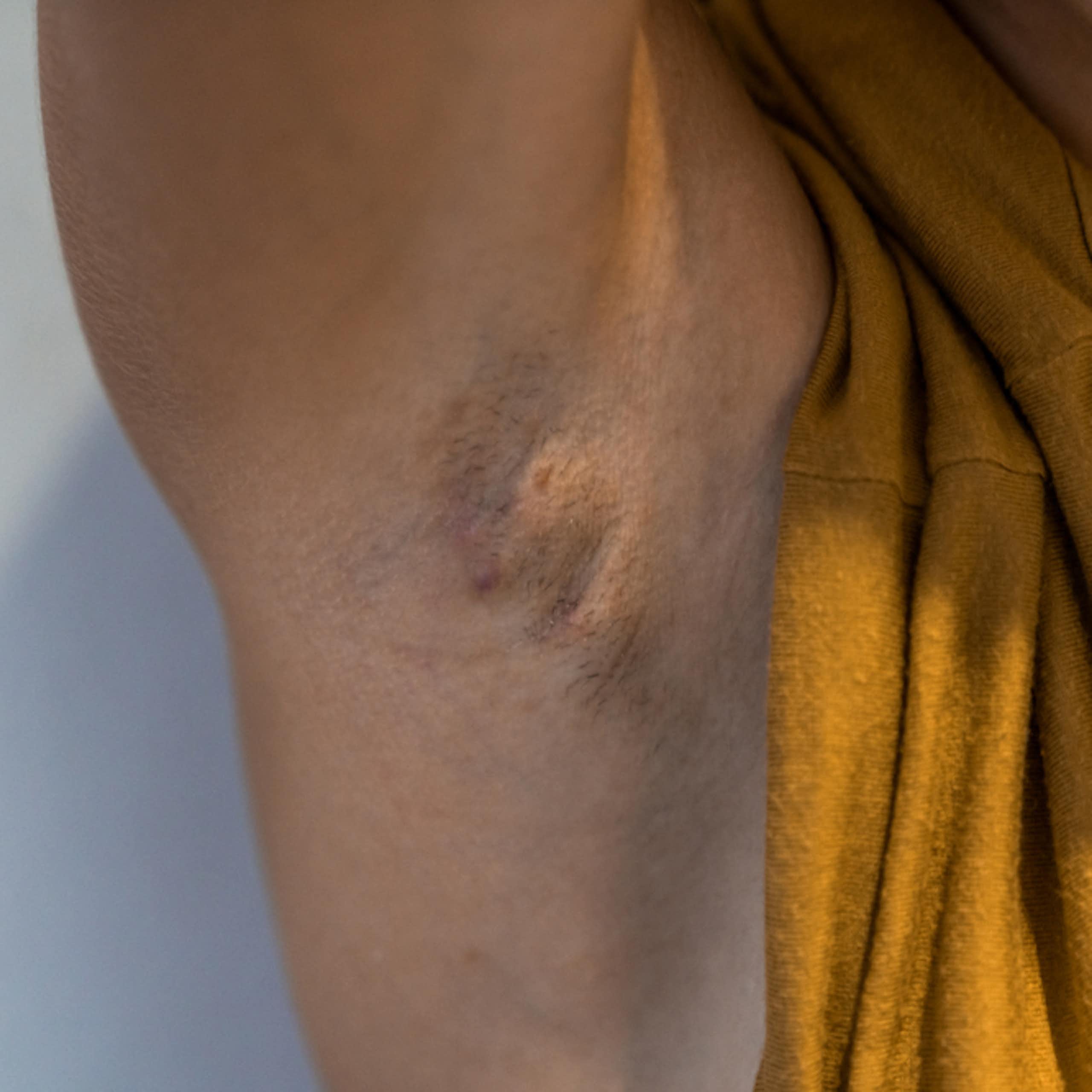 Hidradenitis suppurativa: the painful skin condition that can hide in plain sight