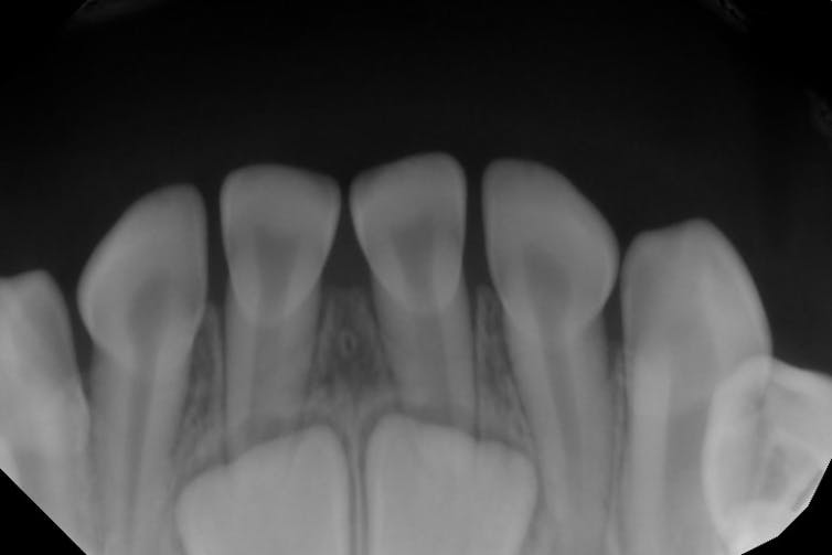 Black-and-white image shows a line of small teeth with roots – under two are two larger white teeth