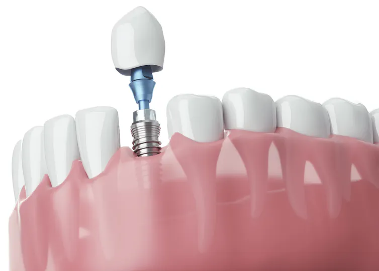 Imagem digital gerada de um dente artificial implantado com um parafuso na base, fixado à mandíbula