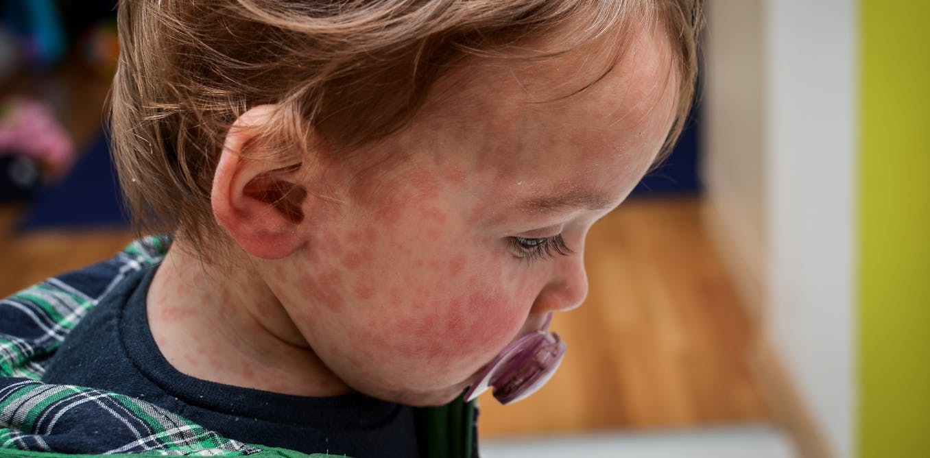 Canada loses its official ‘measles-free’ status – and the US will follow soon, as vaccination rates fall Canada loses its official ‘measles-free’ status – and the US will follow soon, as vaccination rates fall