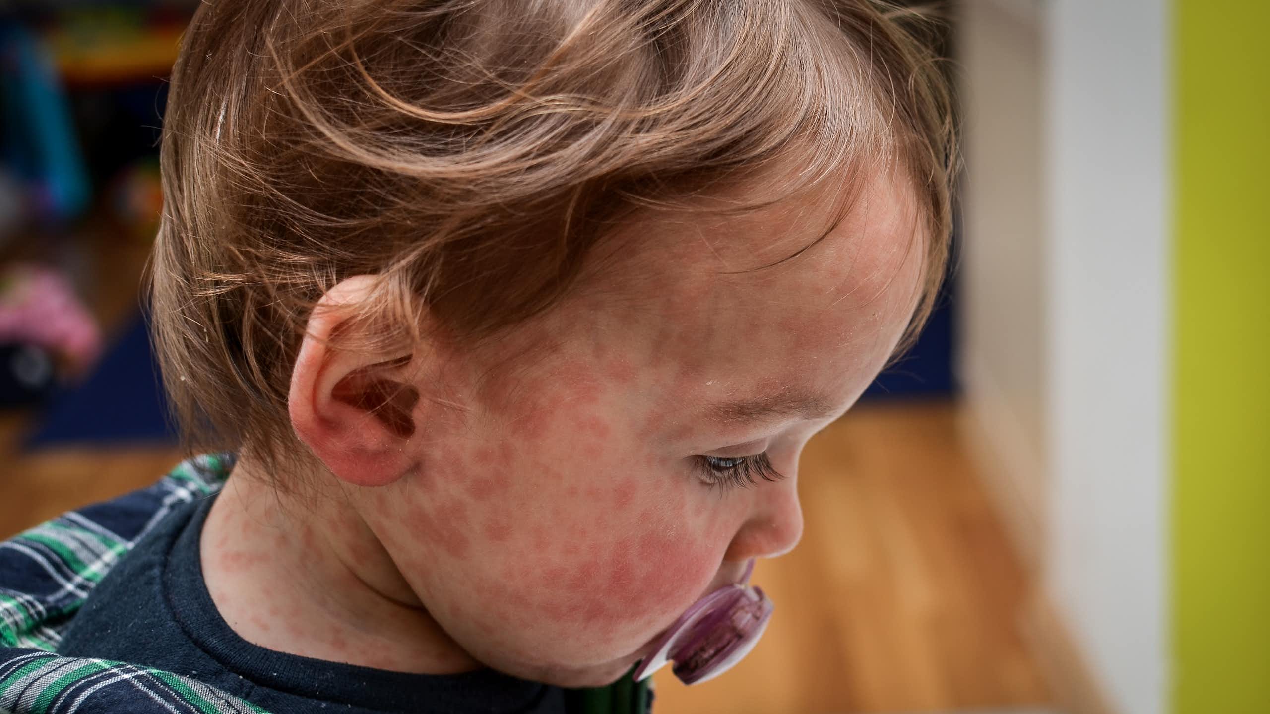 Young child with measles rash on their face