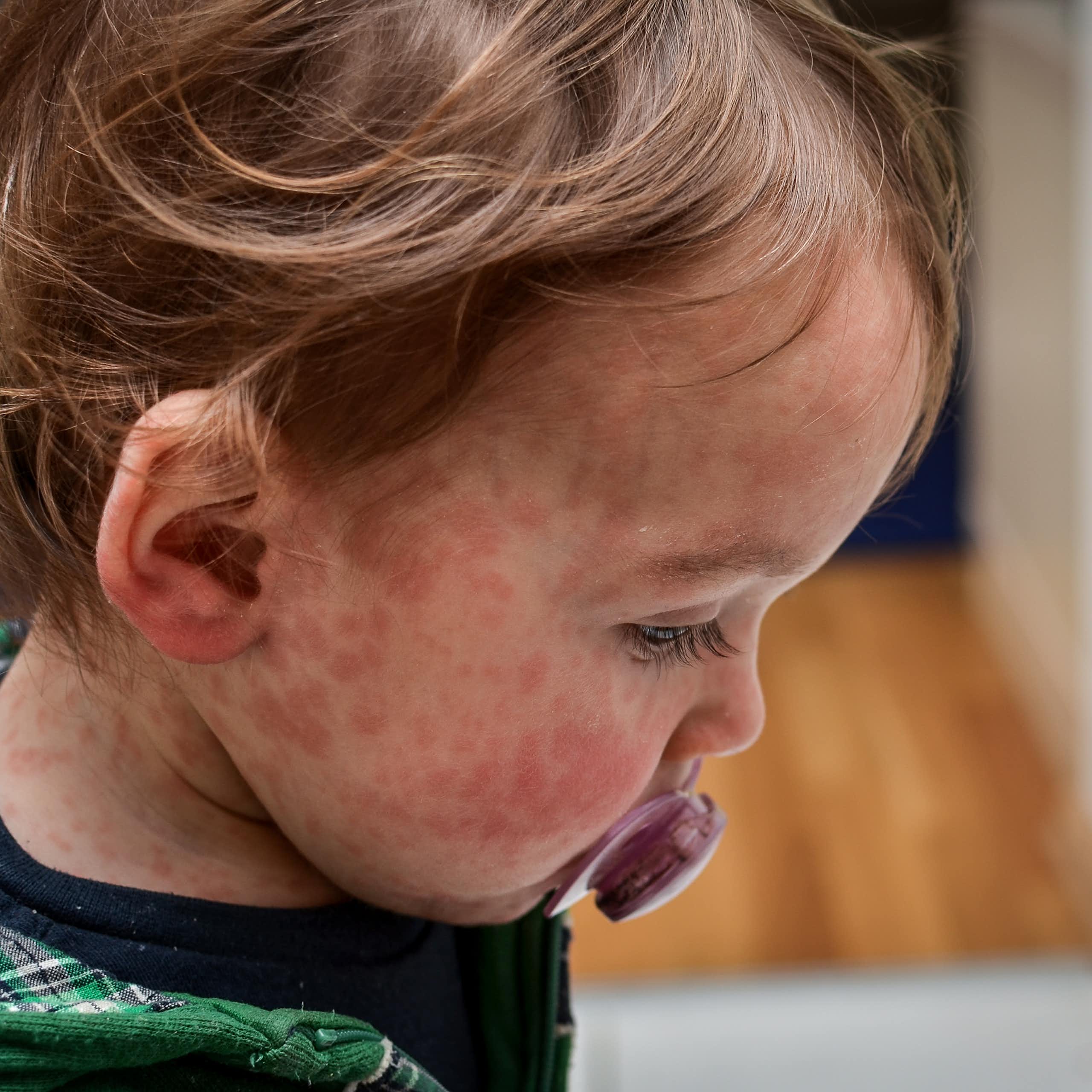 Young child with measles rash on their face