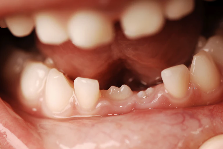 Close-up da boca de uma criança mostrando dentes de leite e dentes permanentes.