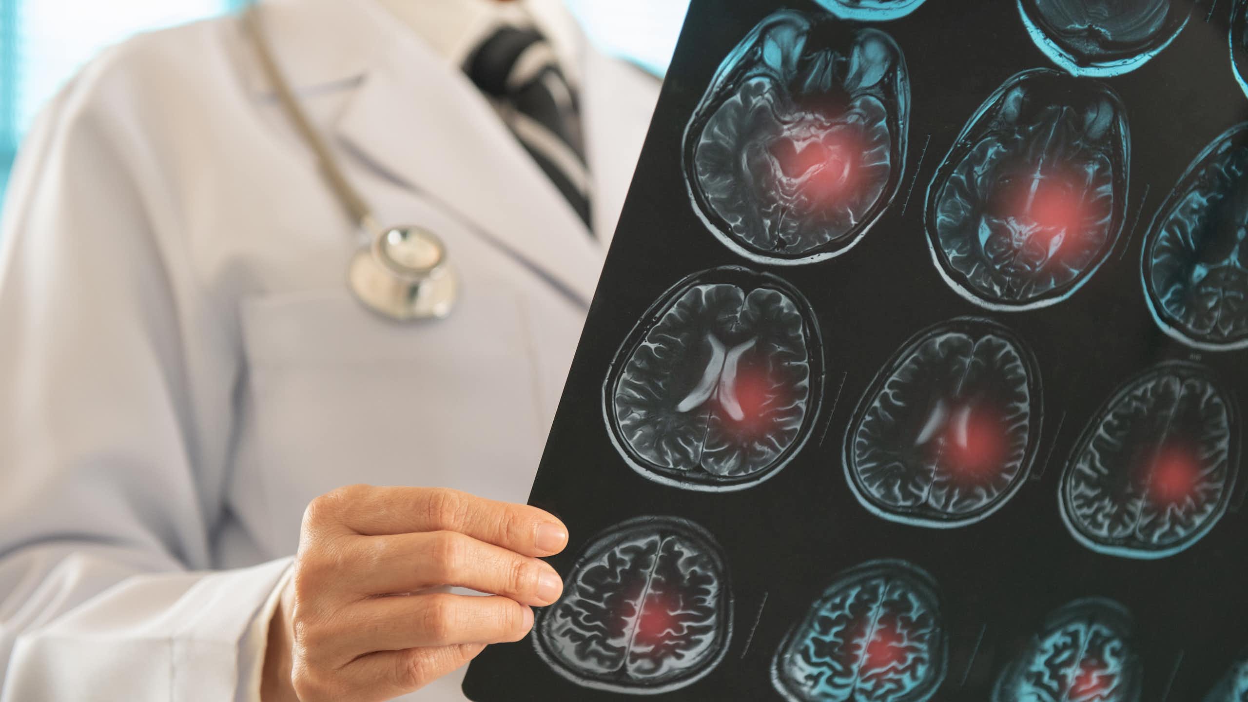 Um médico examina imagens do cérebro de um paciente.