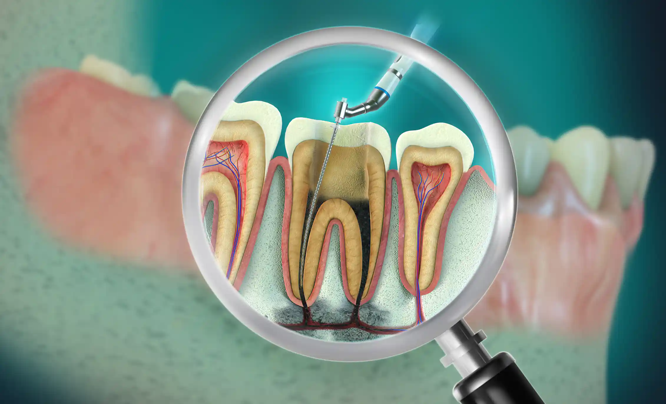 Remove Infection From Tooth How treating a tooth infection can help manage your blood sugar