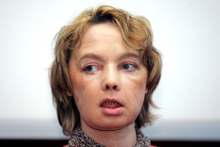 Photo of Isabelle Dinoire, the woman who received the world's first partial face transplant with a new nose, chin and mouth