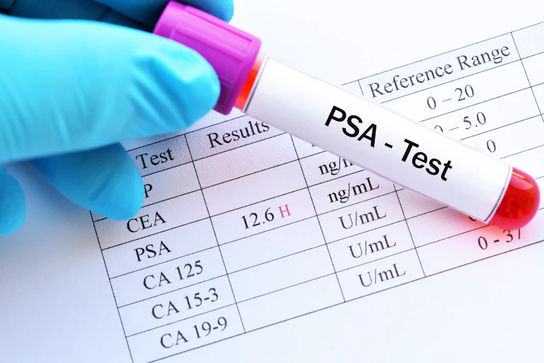 A gloved hand holding a sample of blood with PSA written on the label.
