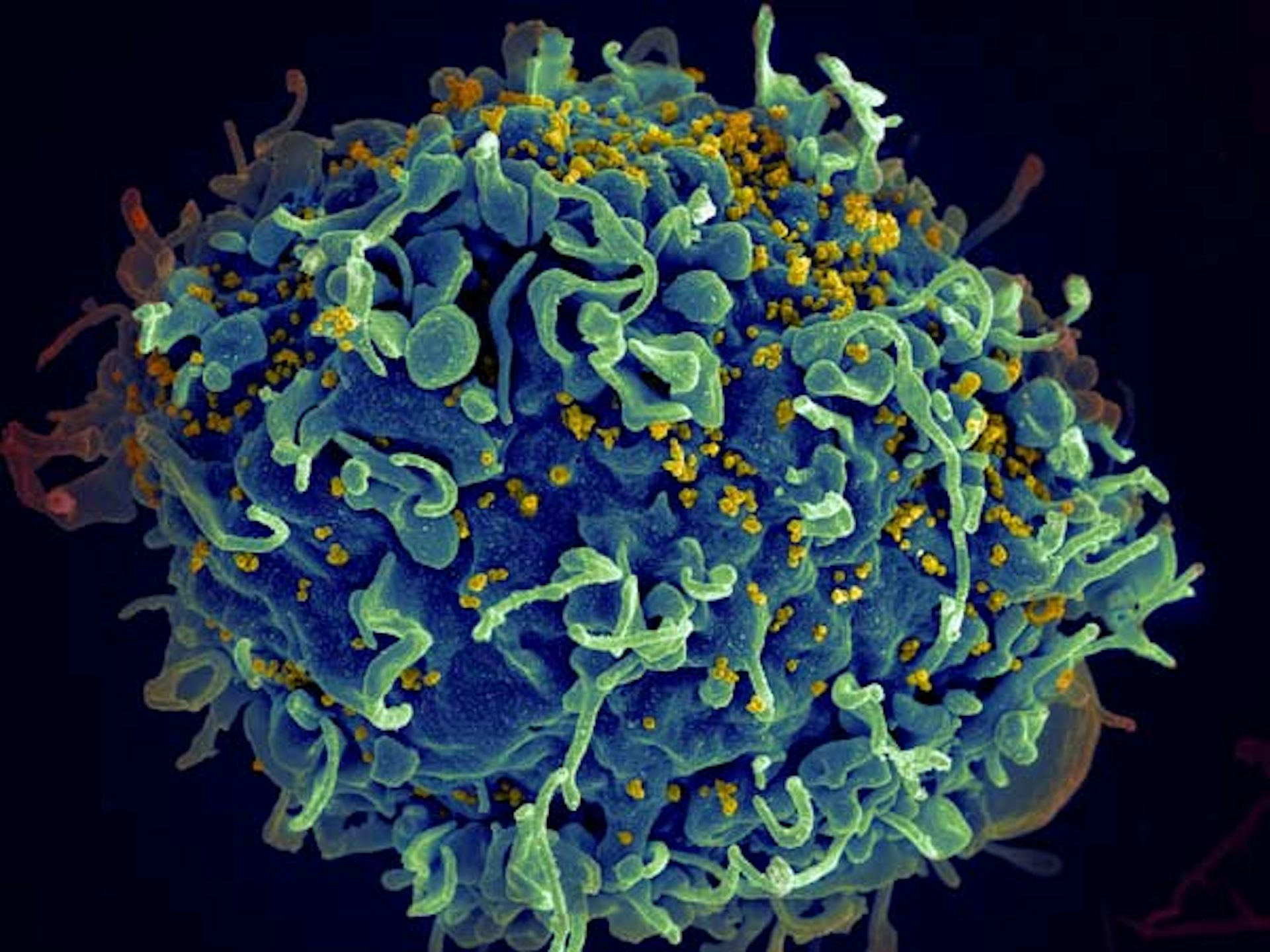 Micrographie d’un lymphocyte T humain (en bleu - fausses couleurs) attaqué par des particules virales du VIH (en jaune - fausses couleurs).